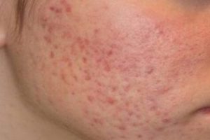 Paano mawala ang pimple marks