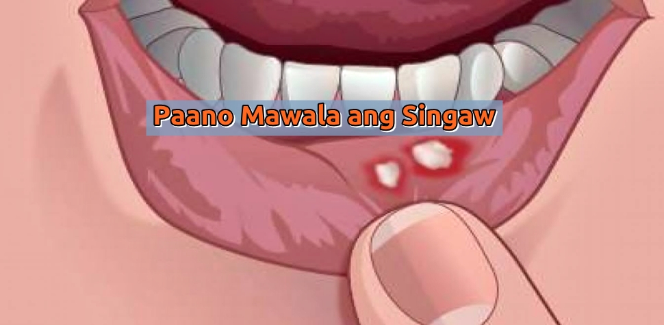 paano mawala ang singaw